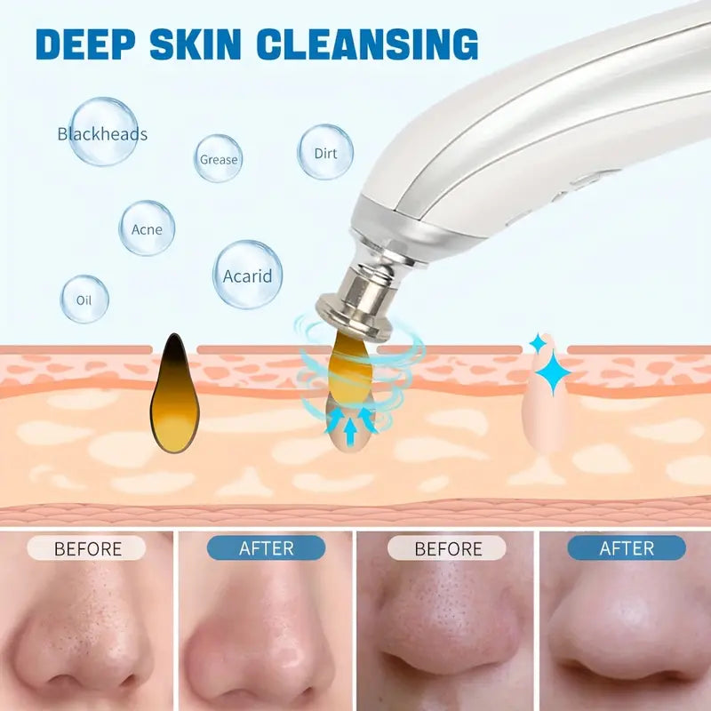 Upgraded Blackhead Remover – Pore Vacuum Cleaner with Adjustable Suction & 5 Probes